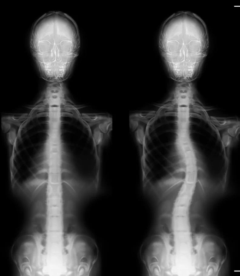 scoliosis Abidjan Côte d’Ivoire